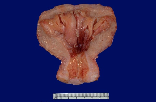 endometrial hyperplasiaFEM019.jpg